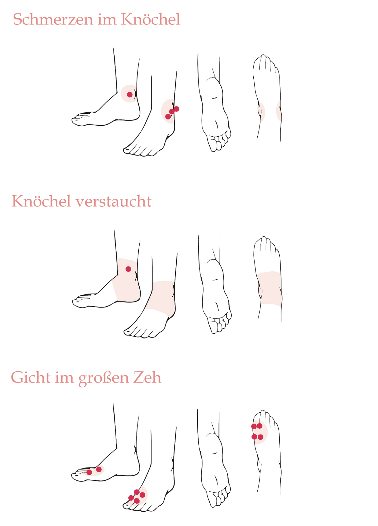 Illustrationen von Fuß und Hand mit markierten Punkten zu den Abschnitten "Schmerzen im Knöchel", "Knöchel verstaucht" und "Gicht im großen Zeh"